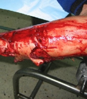 Muşcat de un câine cu rabie, a decapitat animalul la nervi
